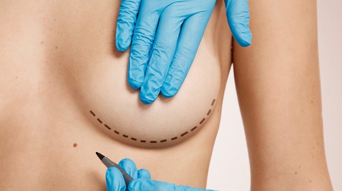 Aumento De Pecho Mixto: Combina Prótesis De Silicona Y Grasa Propia