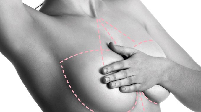 Mastopexia: La Solución Al Pecho Caído