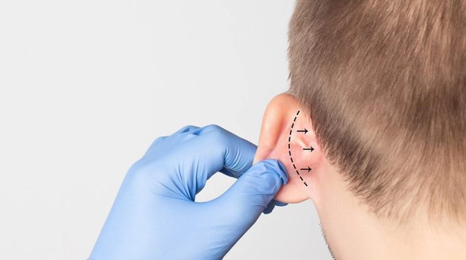 Tratamiento De Otoplastia