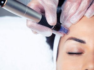 Mesoterapia Facial