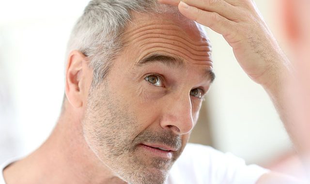 ¿Por Qué Los Hombres Se Quedan Calvos?