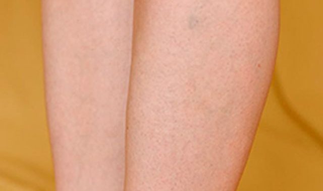 ¿Cómo Quitar Las Varices En Las Piernas?