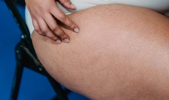 Lipodistrofia: Qué Es, Tipos, Causas Y Tratamientos Recomendados