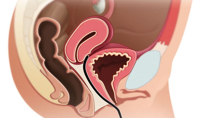 Síndrome Genitourinario: Qué Es, Síntomas Y Tratamiento