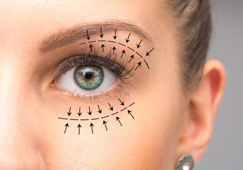 Blefaroplastia Barcelona - Cirugía De Párpados