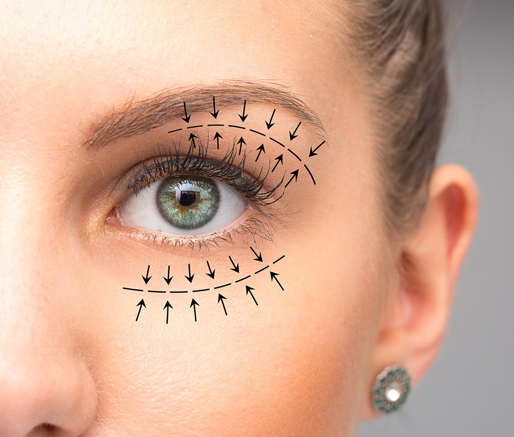 Blefaroplastia Barcelona - Cirugía de Párpados