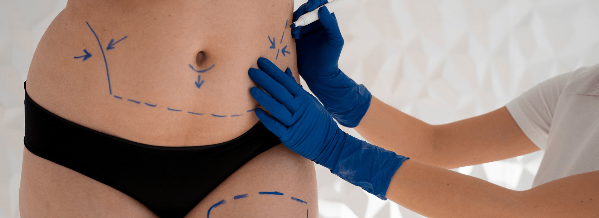 tratamiento de liposucción barcelona